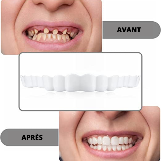 Facette dentaire : Souriez sans complexe